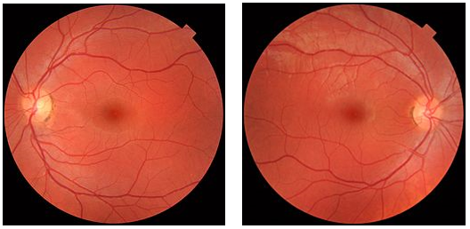 cataract